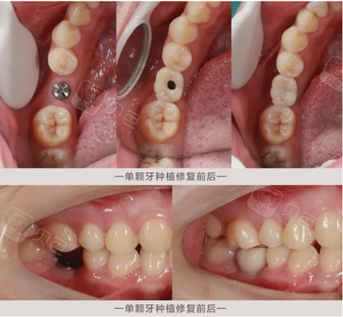 种植牙照片