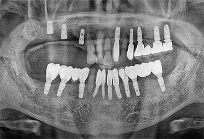 一般全口种植牙的价钱是多少?全口种植上下6颗贵吗?