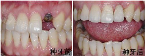 镶牙好还是种牙好烟台口腔医生给你正解