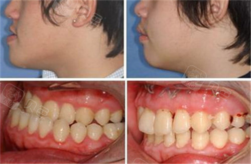 兰州地包天要怎么矫正要多少钱兰州学生矫正牙齿哪里好