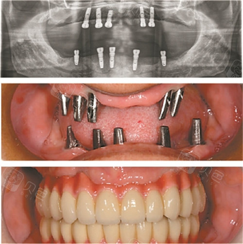 全口种植牙高清实拍