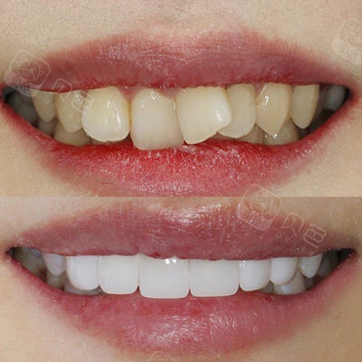 牙齿贴面修复前后效果对比