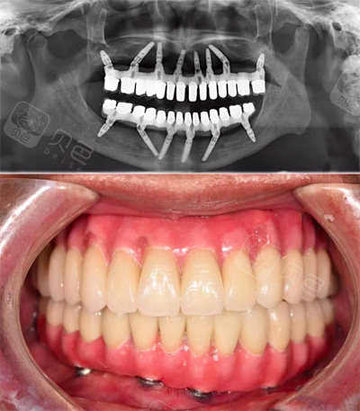 一篇告诉你满口种植牙大概多少钱!