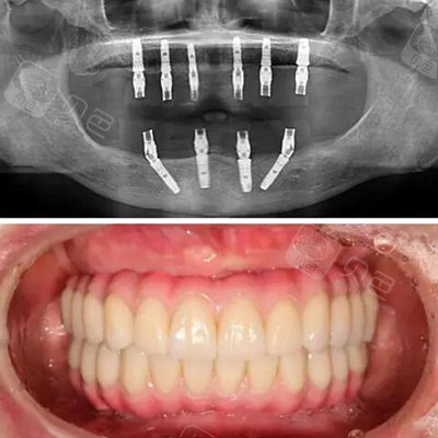 全口种植牙上下6颗要多少钱,10万块全口种植便宜吗?