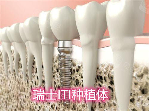 深扒国皓圣种植体优点缺点!