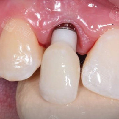 2021厦门种植牙价格表更新!