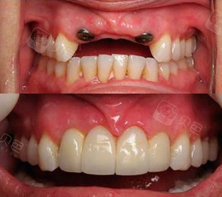 2021厦门种植牙价格表更新!