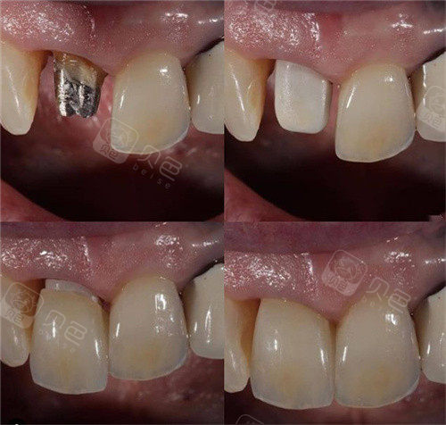 半口牙要种植几颗牙?