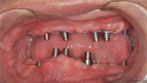 分享我80岁父亲花了10w做全口种植牙的经历,后悔没让他早做!