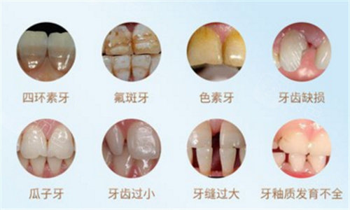 牙齿贴片适应症