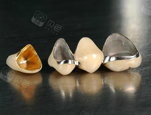 金属材料包含有金合金,钴铬合金,镍铬合金,钛合金,纯钛合金等.