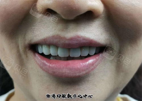 口腔)上面的图片就是用了4颗种植牙来支撑,整个上半口牙齿的图片内容