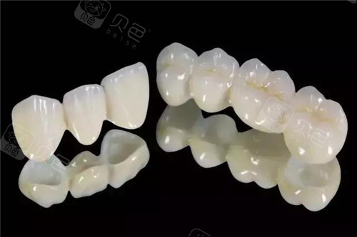 钴铬内冠烤瓷抄牙1200元/颗起