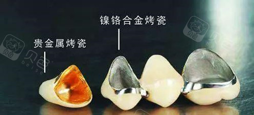 北京牙冠多少钱一颗?烤瓷牙和全瓷牙的区别哪个性价比高?