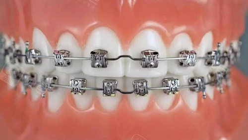 做过种植牙或烤瓷牙还能做牙齿矫正吗 得分情况讨论 贝色口腔