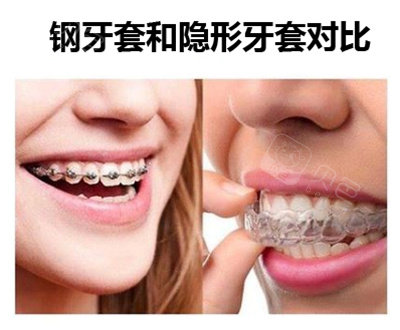 医生推荐的隐适美和钢牙套哪个矫正好?其实各有优势!