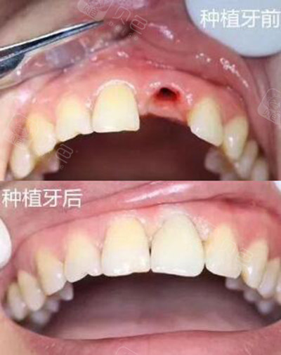 珠海镶牙医院哪里比较好在珠海镶牙多少钱一个