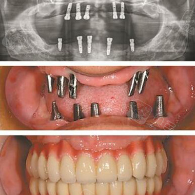 种植牙修复前后对比照片