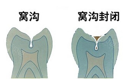 窝沟封闭对比