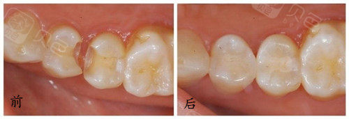 为什么说牙齿有小洞千万别补!补牙会不会越补越烂?