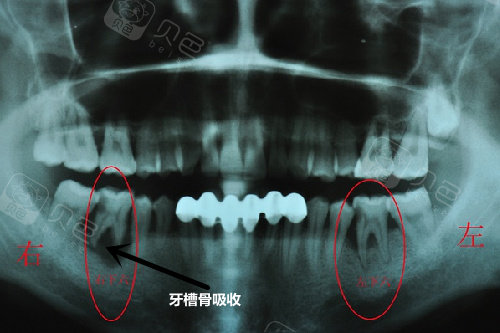 种植牙牙槽骨不够怎么办?