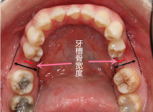 牙槽骨窄可以种植牙吗?种植牙对牙槽骨宽度有什么要求?