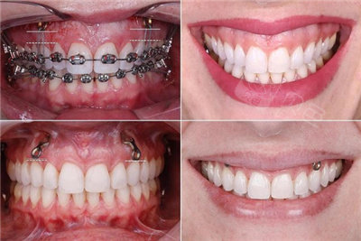矫正支抗钉有什么作用?嘴突露龈笑深覆合,别犹豫打就完了!