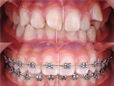 嘴突露龈笑深覆合,别犹豫打就完了!