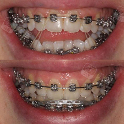 嘴突露龈笑深覆合,别犹豫打就完了!