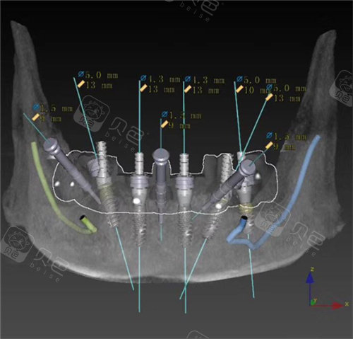 三分钟盘点诺贝尔种植牙pmc与cc和active的区别都是什么
