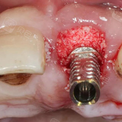 牙槽骨吸收还能种牙吗?揭秘种植牙牙槽骨不够应该如何改善! - 贝色口