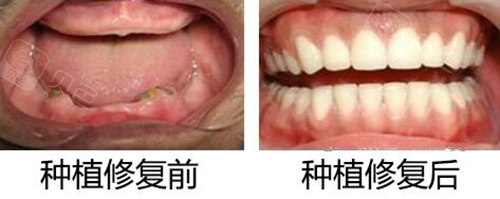 全口种植前后对比照片