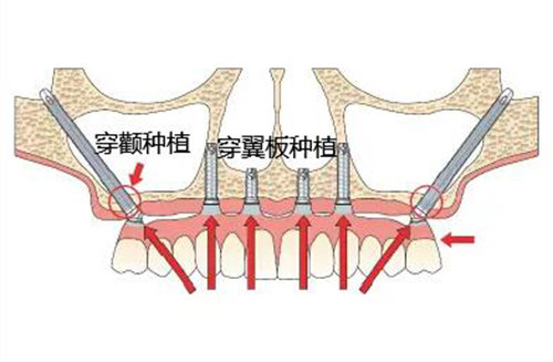 牙槽骨吸收还能种牙吗?揭秘种植牙牙槽骨不够应该如何改善!