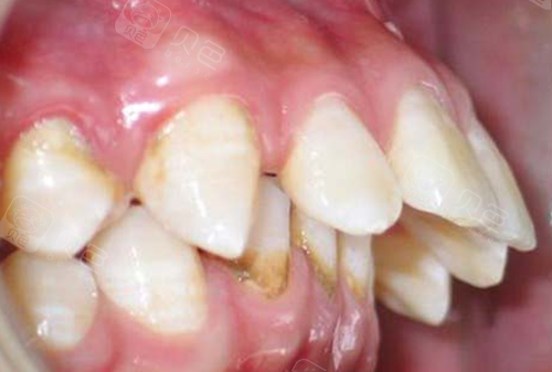 在深圳当地12岁儿童龅牙矫正需要多少钱,该去哪家医院做?