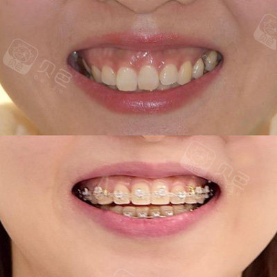 牙齿矫正前后对比