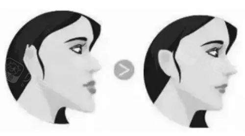 凹面型地包天矫正前后图示