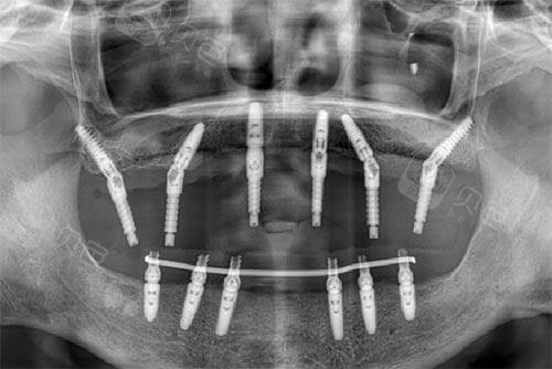 北京哪家医院能做穿颧穿翼种植牙什么情况做穿颧穿翼手术