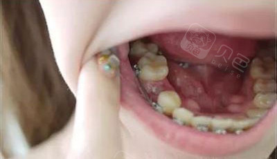 拔牙矫正会瘪嘴吗?正畸可以瘦脸?分享5个关于矫牙的误区