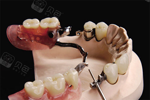 70岁老人全口假牙价目表曝光 价格纯钛>bpd>树脂! - 贝色口腔