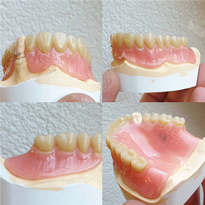 全口吸附性义齿收费价格是多少?吸附性义齿的优缺点有哪些?