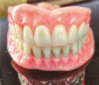 全口吸附性义齿收费价格是多少?吸附性义齿的优缺点有哪些?