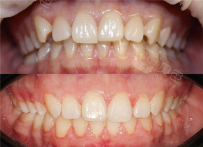 牙齿轻微不齐矫正前后对比