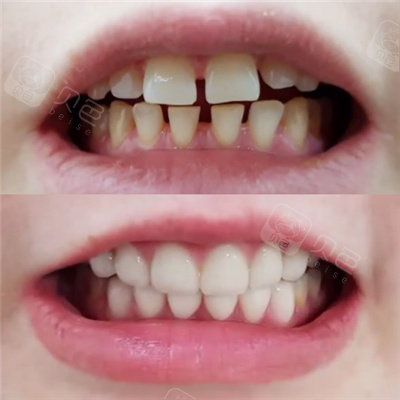 牙齿有一点点不齐有必要矫正吗?轻微歪斜也需要矫正吗?