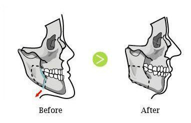 地包天骨骼表现