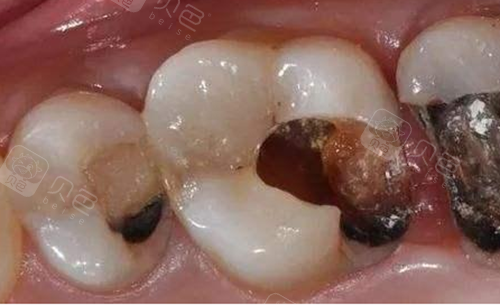 牙齿龋坏照片