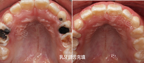 中山小孩补牙需要全麻吗?看小孩牙好的医院有哪几家?