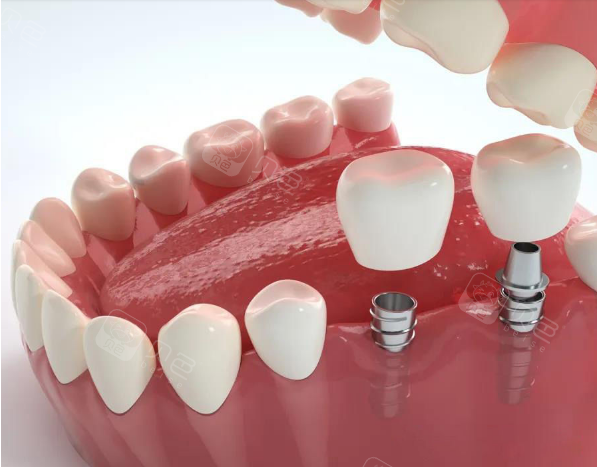 种植牙安装牙冠图