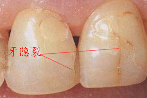 裂开的牙齿还能治好吗?