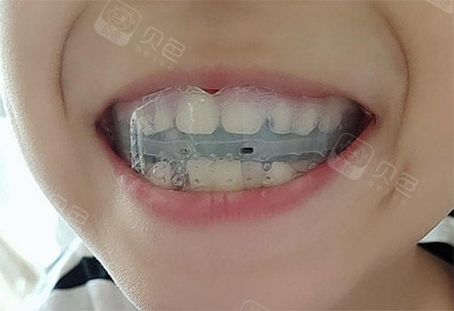 小孩子整牙齿多大年龄好?我来曝光儿童正畸时间段! - 贝色口腔