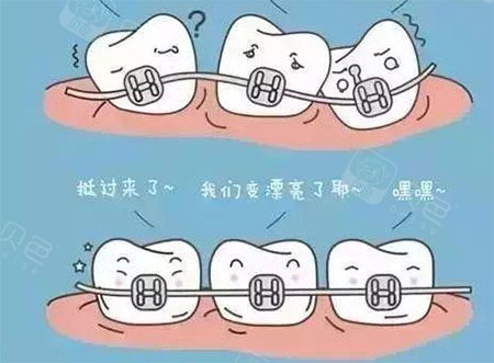 牙齿矫正动画图